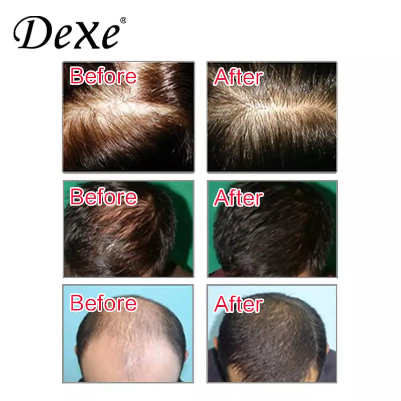 Dexe Anti-hair Loss Lotion 100ml