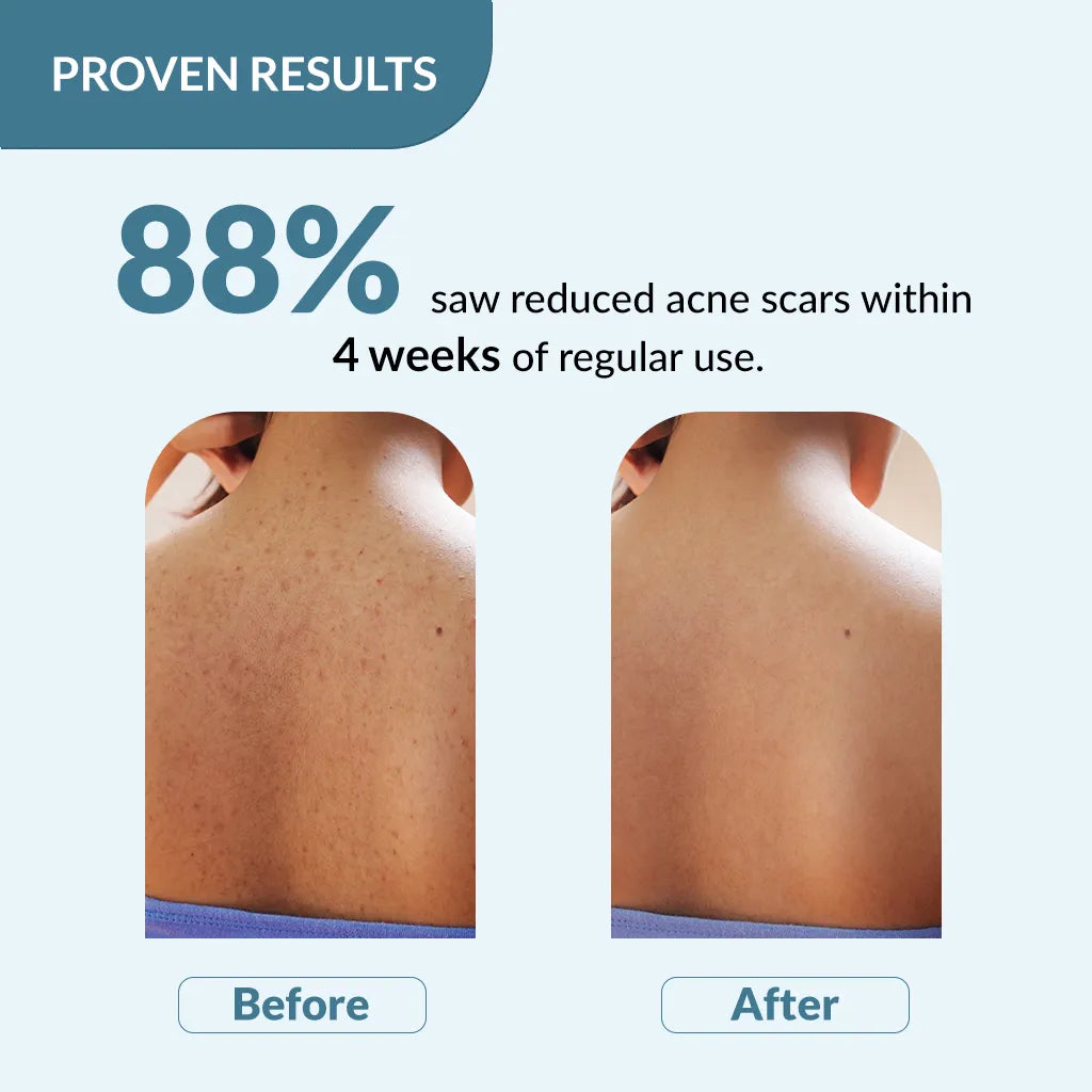 Fix Derma Salyzap Body Wash | Soap-Free Wash to Combat Stubborn Body Acne