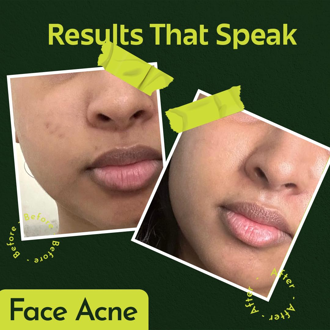 Rivona Genie Hypochlorous acid spray l Soothing Anti-bacterial & Anti-inflammatory toner l With rose water l Alcohol & Fragrance-free l Multipurpose Face & Body Spray | Gentle and safe Sensitive, Irritated, Or Acne-Prone Skin - 50ml