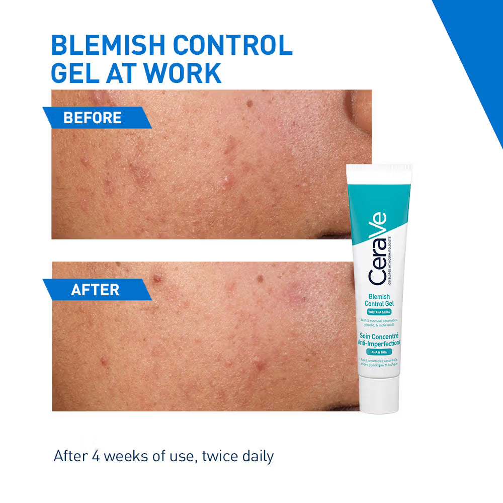CeraVe Blemish Control Gel with 2% Salicylic Acid, AHA & Niacinamide for Acne Spot Treatment (40ml)