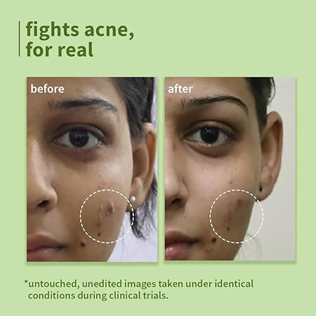 Plum Green Tea Pore Cleansing Face Wash for Oily, Acne Prone, Dry & Combination Skin | with Glycolic Acid | Fight Pimples & Control Excess Oil | Gentle Exfoliating & Non-Drying | Women & Men | 100ml